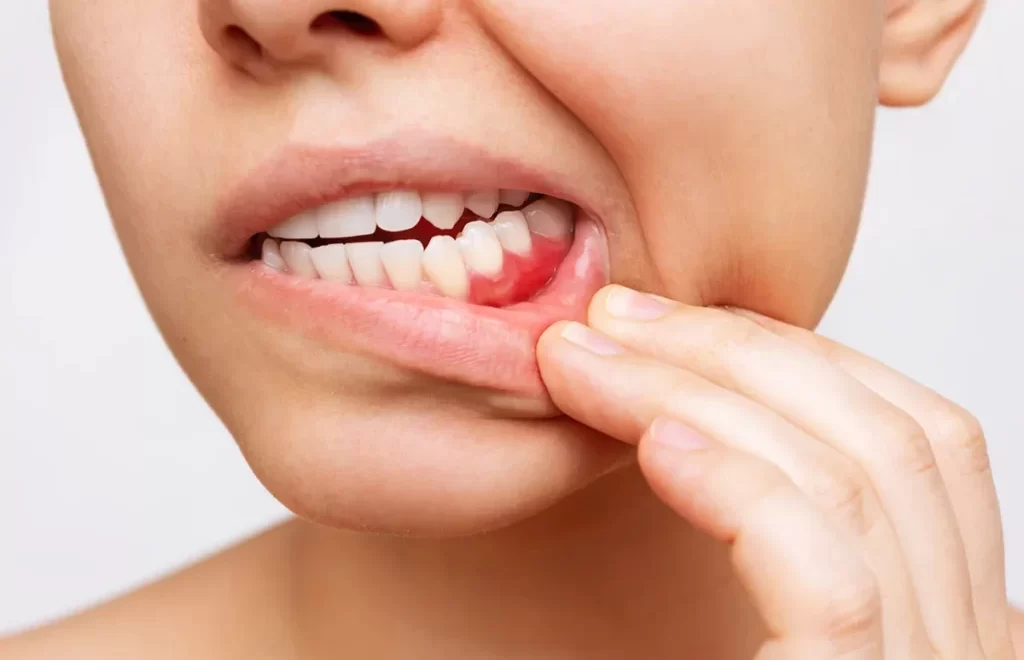 gum inflammation cropped shot young woman showing red bleeding gums 1024x683