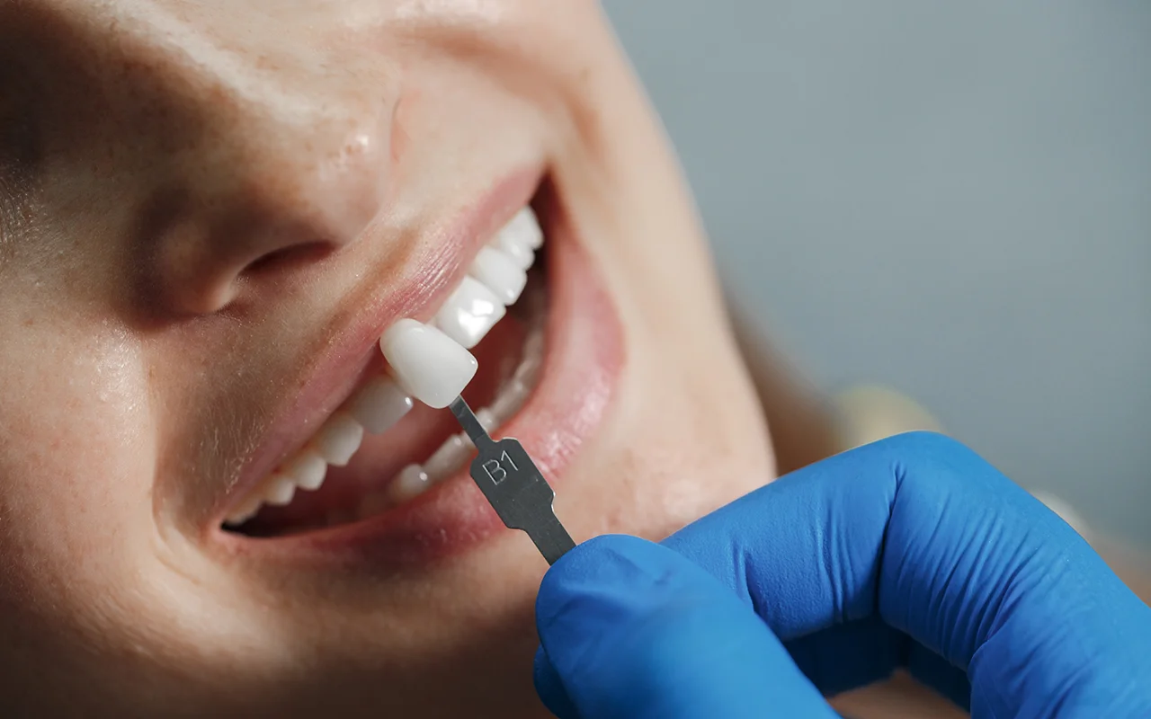 faceta dentaria tratamento