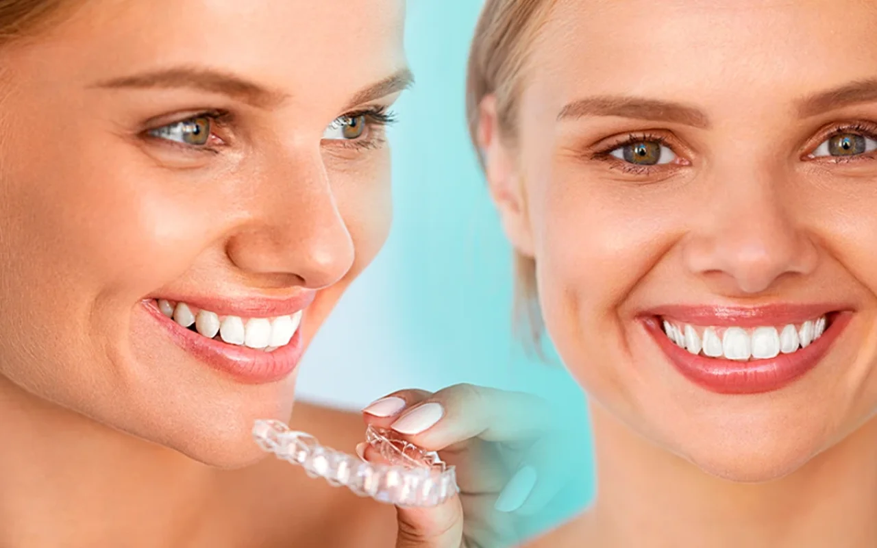 invisalign slide 02